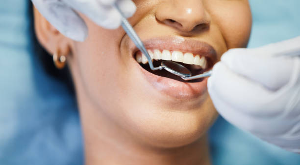 Best Emergency Dentist for Lost Fillings or Crowns in Romeo, MI