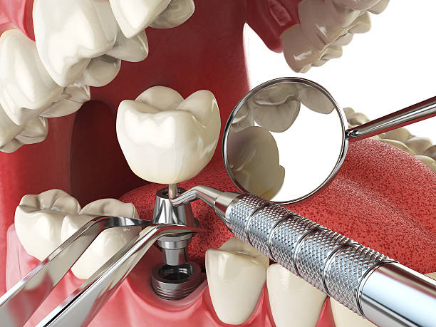 Best Emergency Root Canal Treatment in Romeo, MI